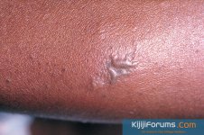 Gonococcal_lesion_on_the_skin_PHIL_2038_lores.jpg